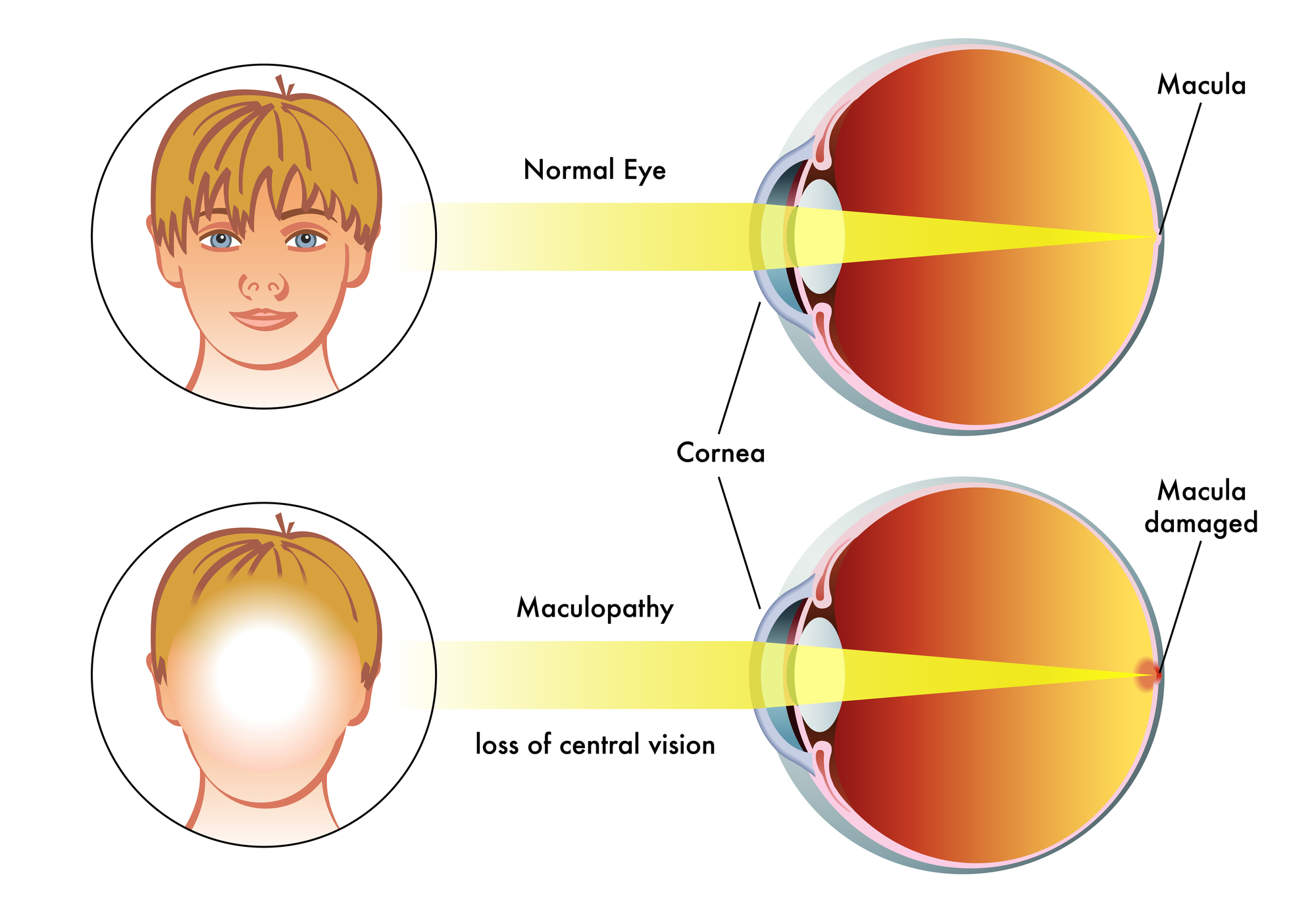 Макулопатия глаза. Миопической макулопатии. Макулопатия правого глаза. Диффузная макулопатия.