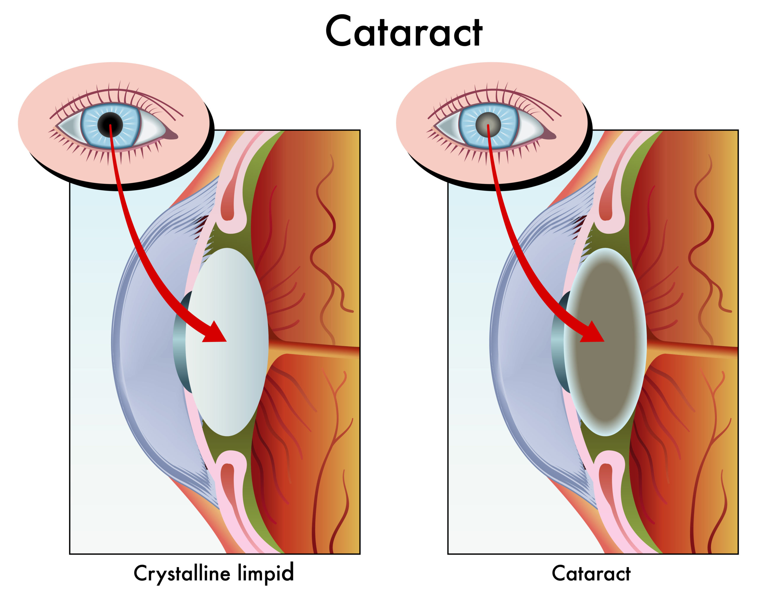 Катаракта слезится глаз. Капсулярная врожденная катаракта. Катаракта – помутнение хрусталика глаза.. Миопизирующая катаракта. Факоэмульсификация катаракты с имплантацией.