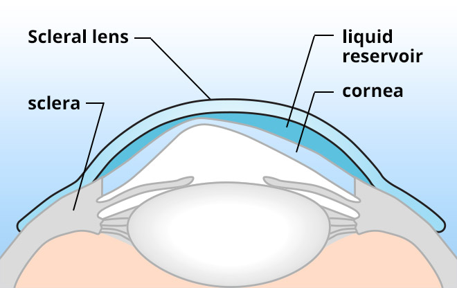 diagram of contact lenses